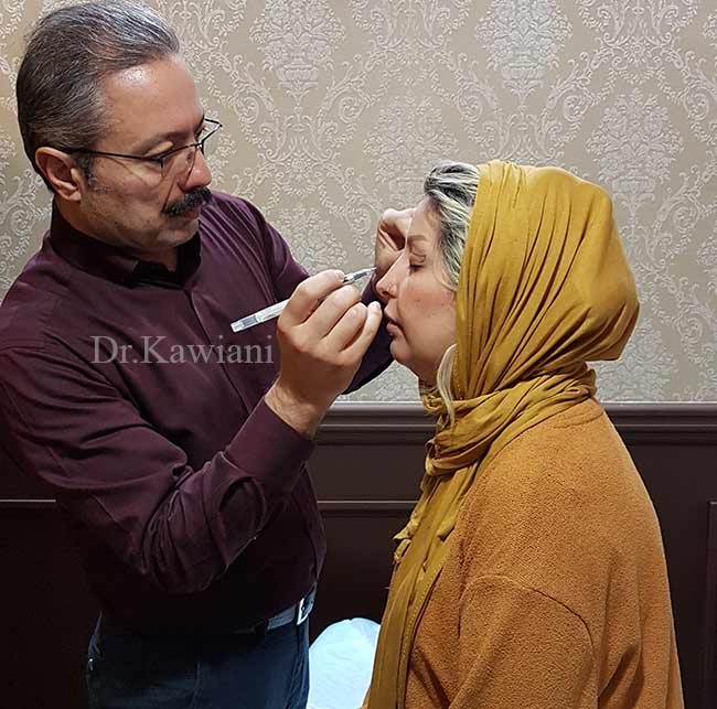 جراحی پلک در مشهد دکتر کامران کاویانی
