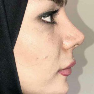عمل بینی در مشهد توسط بهترین جراح بینی مشهد بهترین جراح پلاستیک ایران