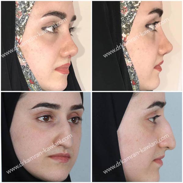 قبل و بعد از عمل بینی غضروفی در مشهد - دکتر کاویانی فر