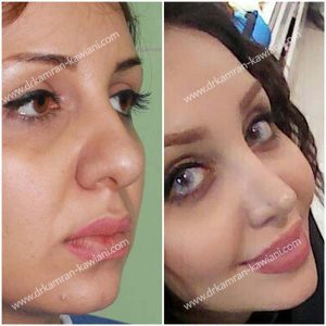 قبل و بعد از عمل بینی گوشتی در مشهد - دکتر کاویانی فر