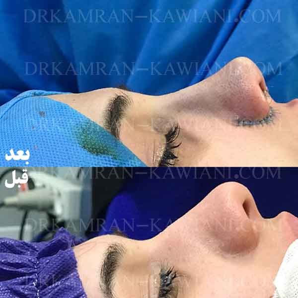 تصاویر بهترین جراحی زیبایی بینی قبل و بلافاصله بعد از عمل