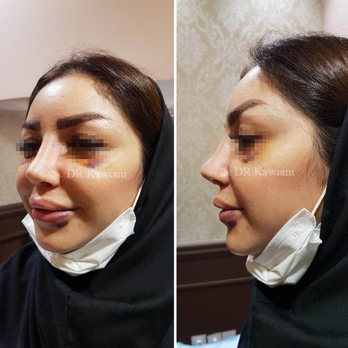 تفاوت بینی گوشتی و استخوانی جراحی زیبایی بینی جراح بینی خوب متخصص جراحی گوش و حلق و بینی دکتر سید هادی حسینی نسب