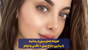 هزینه و قیمت عمل بینی در مشهد با بهترین جراح بینی