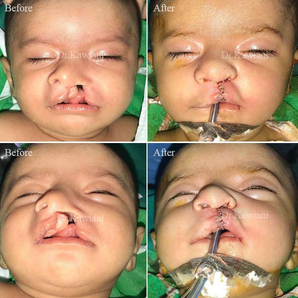 جراحی لب شکری در مشهد - قبل و بعد عمل لب شکری