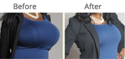 قبل و بعد از عمل کوچک کردن سینه