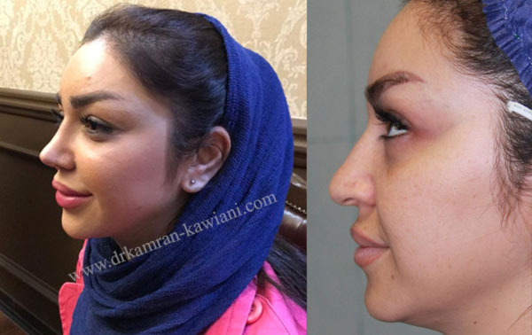 قبل و بعد از عمل بینی در مشهد