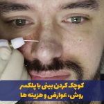 پلکسر بینی در مشهد - عوارض و هزینه ها