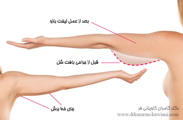 عمل لیفت بازو در مشهد - عکس قبل و بعد لیفت بازو