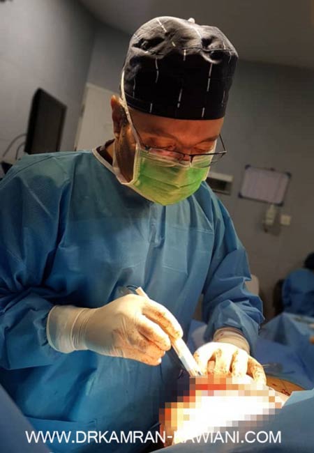 مراقبت بعد از پروتز سینه - عمل پروتز سینه در مشهد با دکتر کاویانی فر